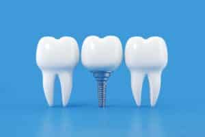 Εμφυτεύματα Δοντιών 11 Άμεση Φόρτιση Εμφυτευμάτων