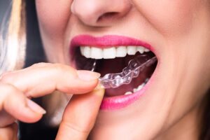 Κροταφογναθικό Σύνδρομο 18 Σφίξιμο Δοντιών