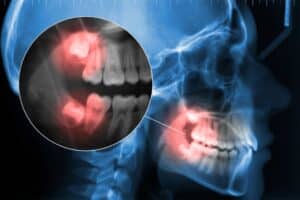 Φρονιμίτης & Εξαγωγή 28 εξαγωγή φρονιμίτη
